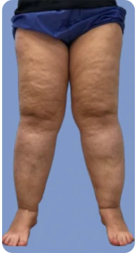 Lipedema etapa 3