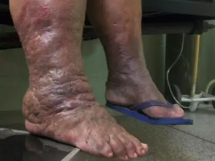 Linfedema en las piernas